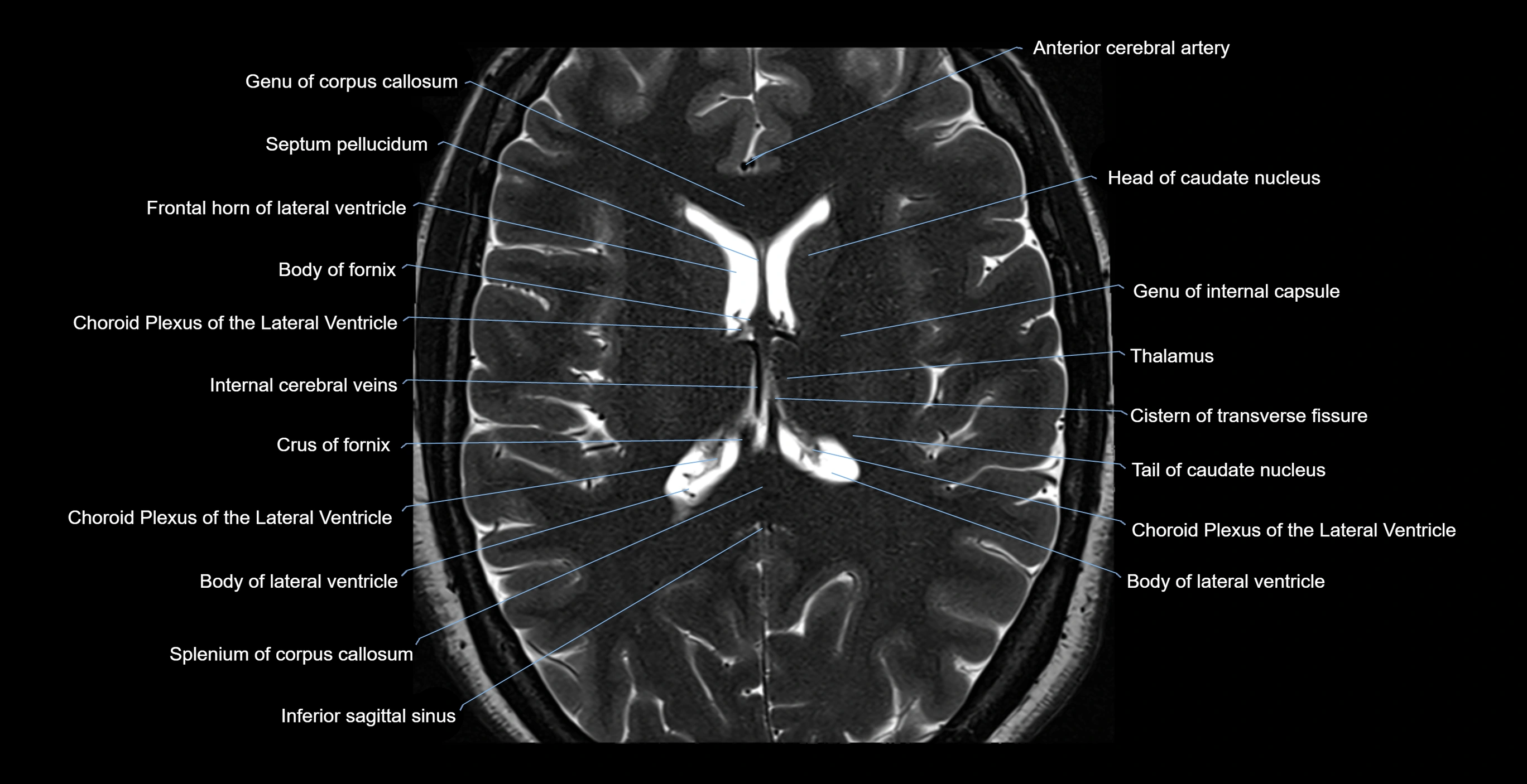 brain axial anatomy 3T MRI images -img-17001-00038.webp